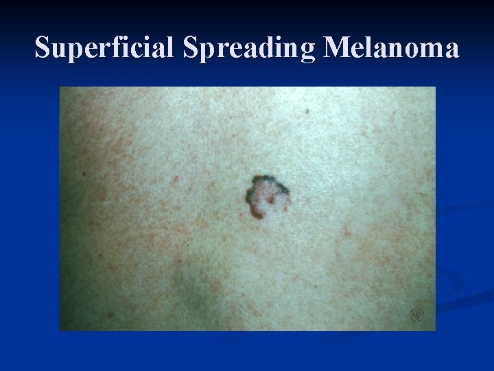 Superficial Spreading Melanoma 