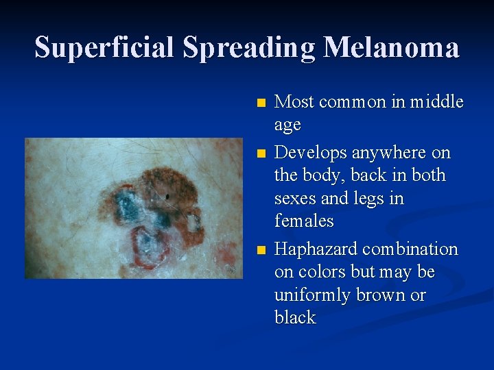 Superficial Spreading Melanoma n n n Most common in middle age Develops anywhere on