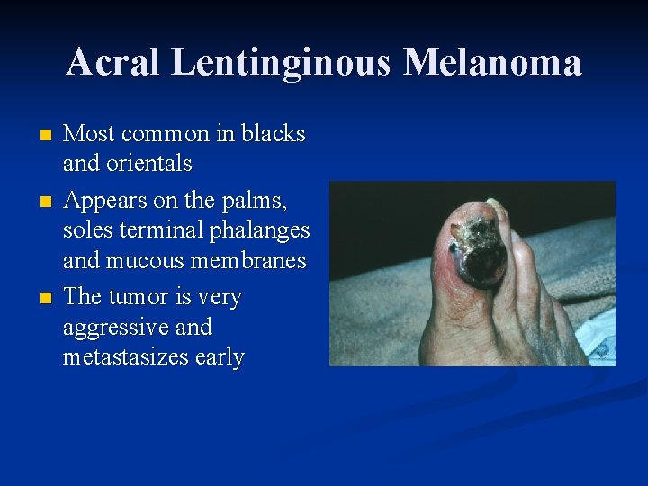 Acral Lentinginous Melanoma n n n Most common in blacks and orientals Appears on