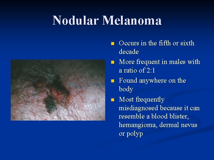 Nodular Melanoma n n Occurs in the fifth or sixth decade More frequent in