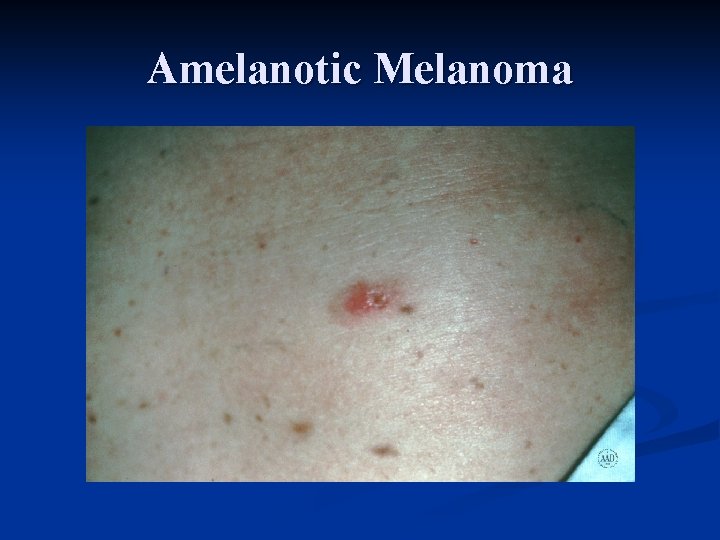 Amelanotic Melanoma 