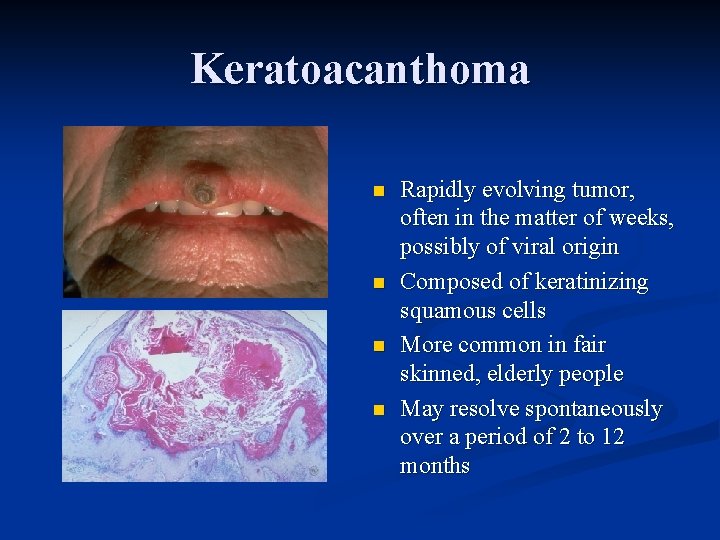 Keratoacanthoma n n Rapidly evolving tumor, often in the matter of weeks, possibly of