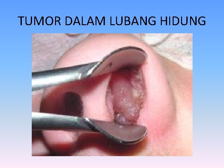 TUMOR DALAM LUBANG HIDUNG 