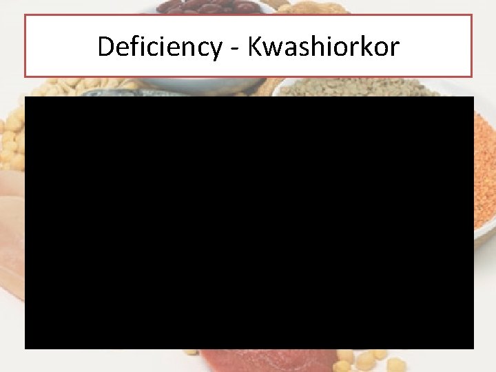 Deficiency - Kwashiorkor 