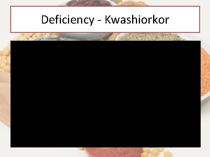 Deficiency - Kwashiorkor Deficiency - Kwashiorkor