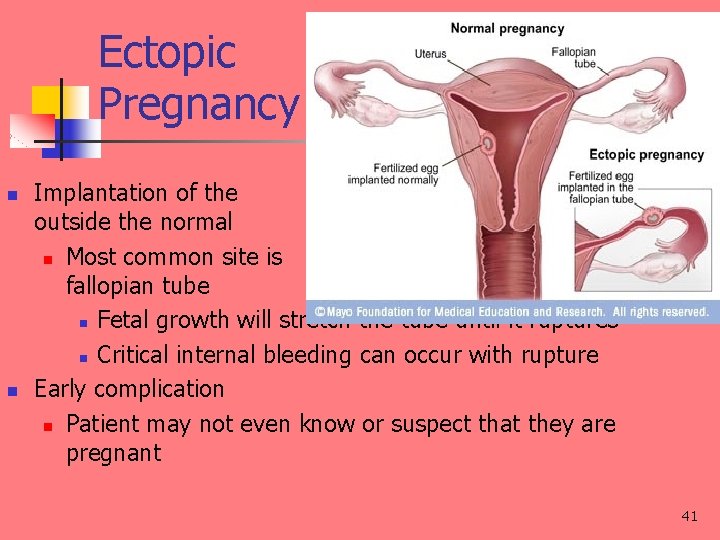Ectopic Pregnancy n n Implantation of the egg outside the normal uterus n Most