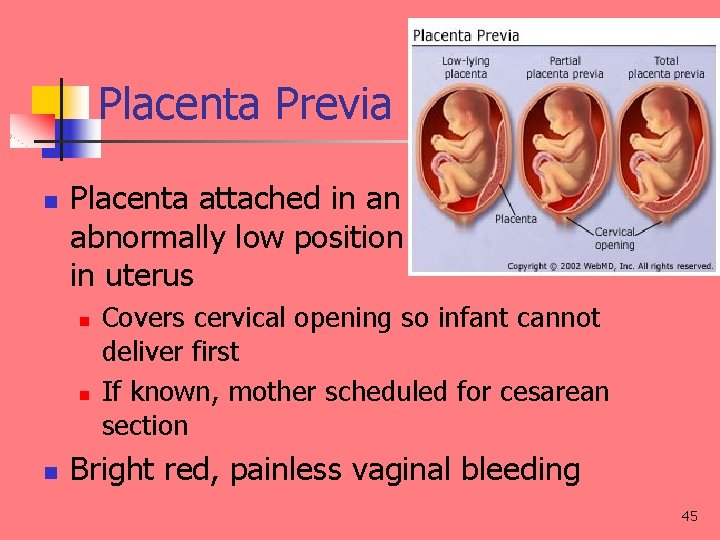 Placenta Previa n Placenta attached in an abnormally low position in uterus n n