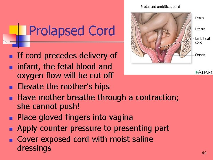Prolapsed Cord n n n n If cord precedes delivery of infant, the fetal