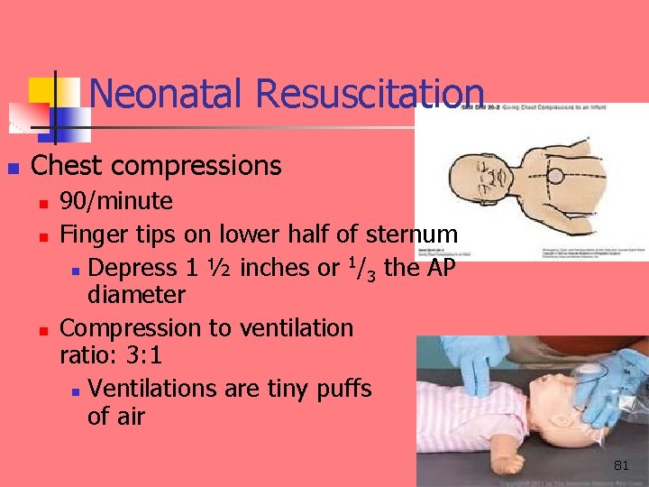Neonatal Resuscitation n Chest compressions n n n 90/minute Finger tips on lower half