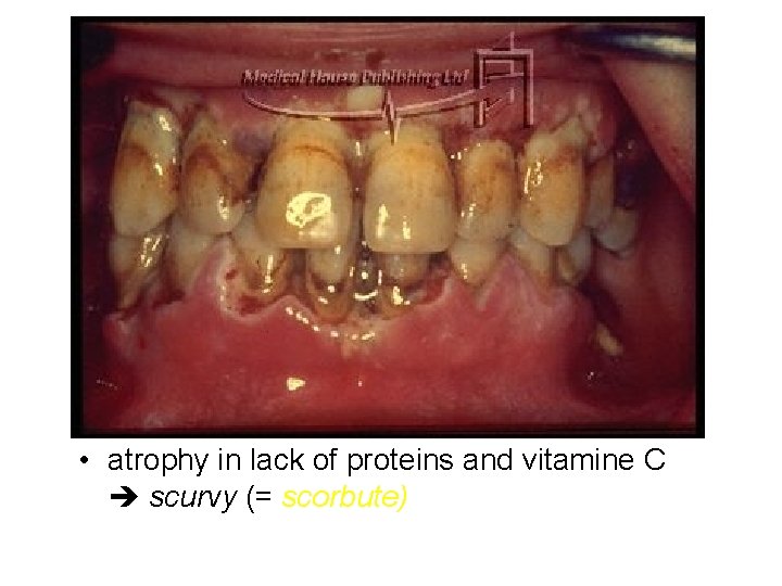 Peridontium • ligaments between tooth and alveolus (fixed firmly into bone) • collagen fibres