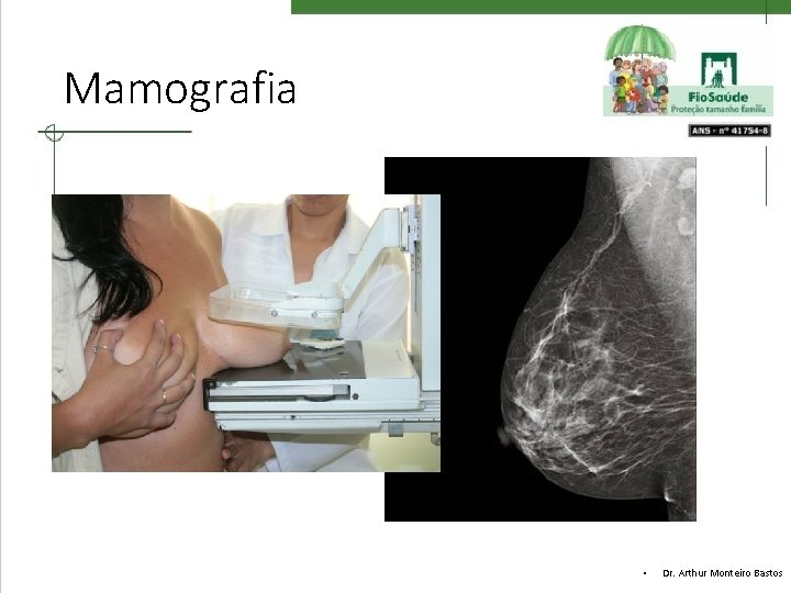 Mamografia • Dr. Arthur Monteiro Bastos 