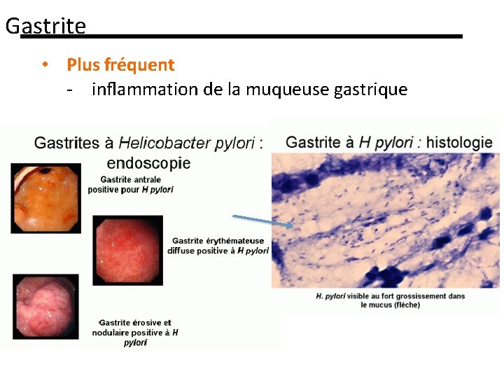 Gastrite • Plus fréquent - inﬂammation de la muqueuse gastrique 