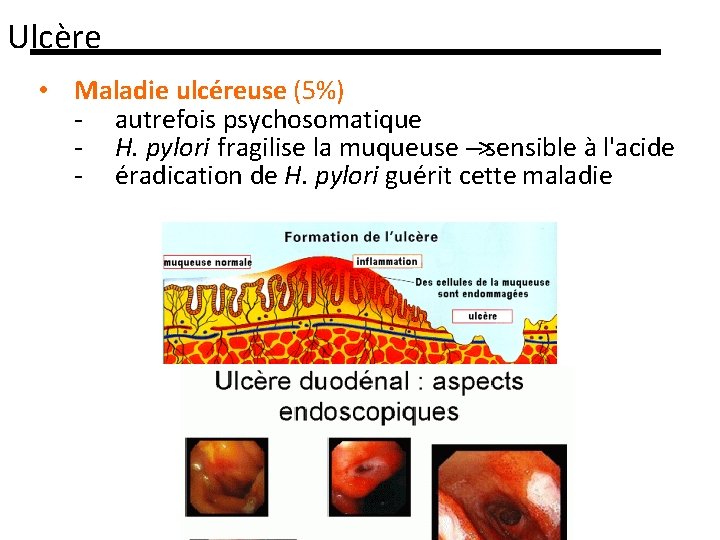 Ulcère • Maladie ulcéreuse (5%) - autrefois psychosomatique - H. pylori fragilise la muqueuse