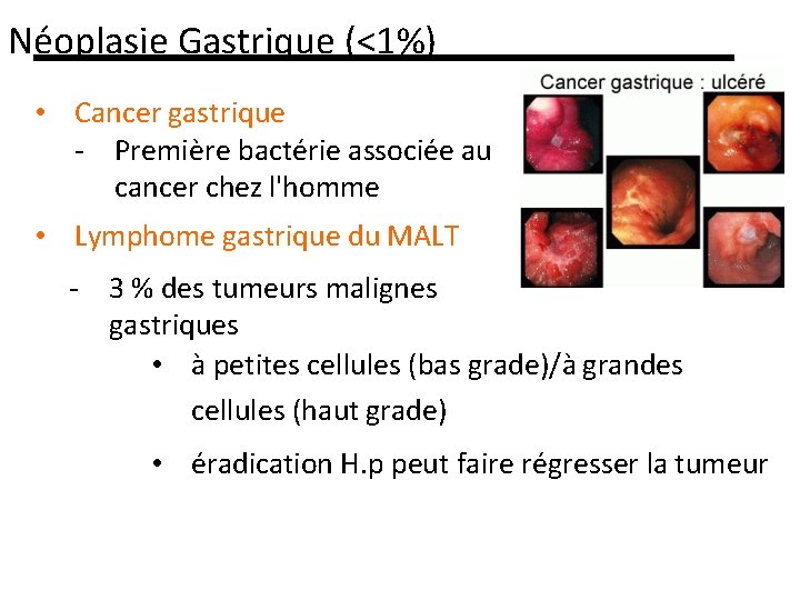 Néoplasie Gastrique (<1%) • Cancer gastrique - Première bactérie associée au cancer chez l'homme