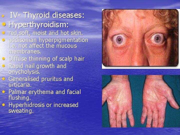 IV- Thyroid diseases: • Hyperthyroidism: • • red, soft, moist and hot skin. •