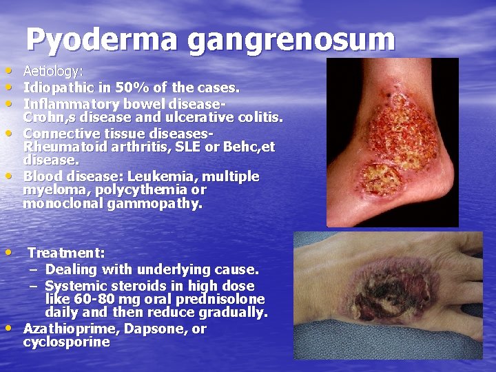 Pyoderma gangrenosum • Aetiology: • Idiopathic in 50% of the cases. • Inflammatory bowel