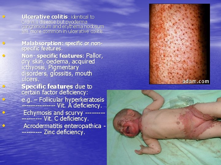  • Ulcerative colitis: identical to • Malabsorption: specific or nonspecific features. Non- specific