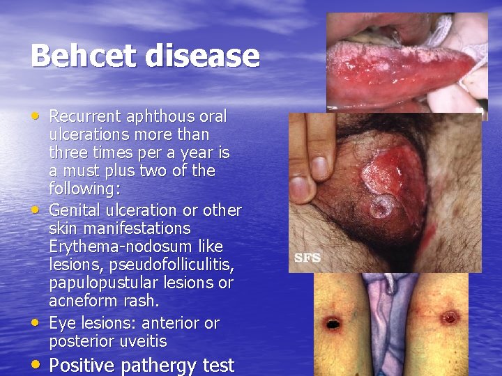 Behcet disease • Recurrent aphthous oral • • ulcerations more than three times per