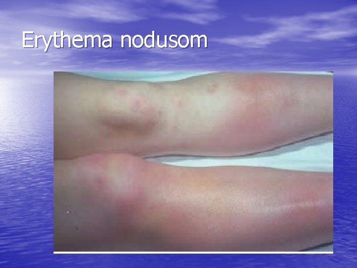 Erythema nodusom 