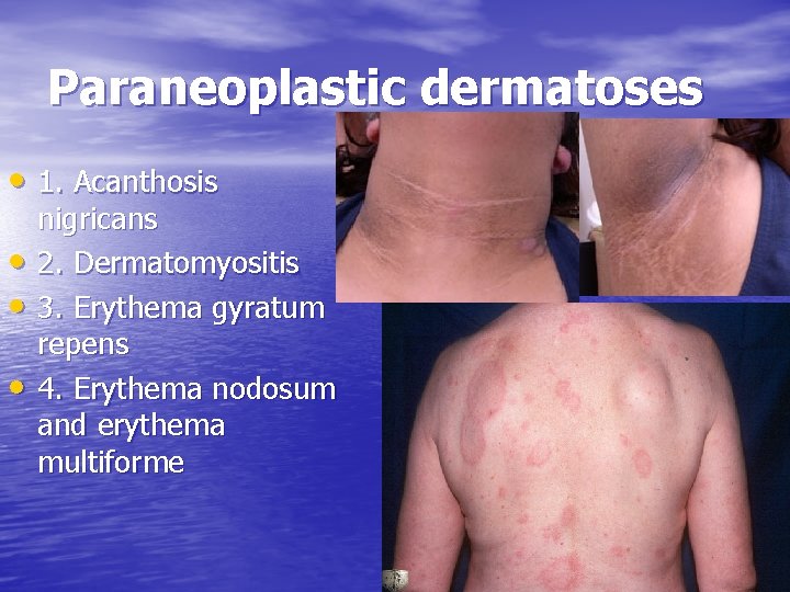 Paraneoplastic dermatoses • 1. Acanthosis • • • nigricans 2. Dermatomyositis 3. Erythema gyratum