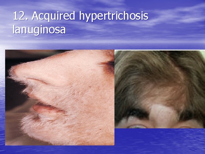 12. Acquired hypertrichosis lanuginosa 