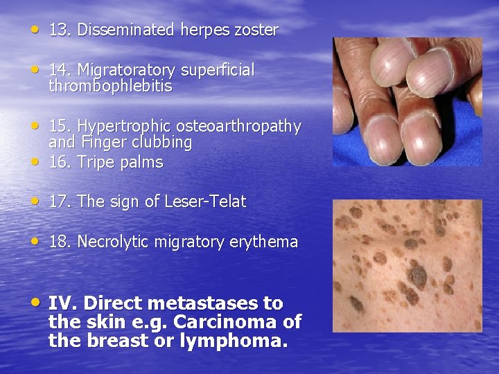  • 13. Disseminated herpes zoster • 14. Migratory superficial thrombophlebitis • 15. Hypertrophic