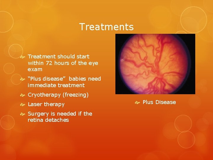 Treatments Treatment should start within 72 hours of the eye exam “Plus disease” babies