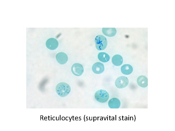 Reticulocytes (supravital stain) 