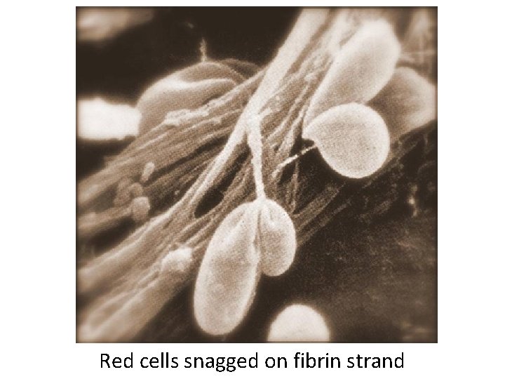 Red cells snagged on fibrin strand 