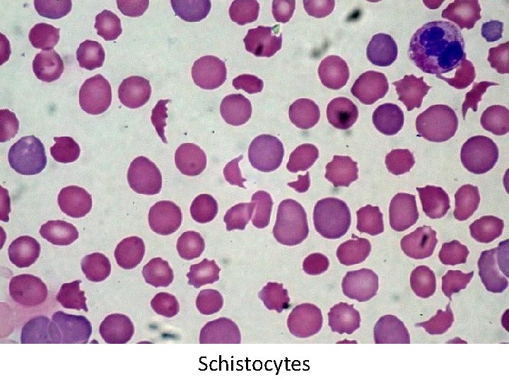 Schistocytes 