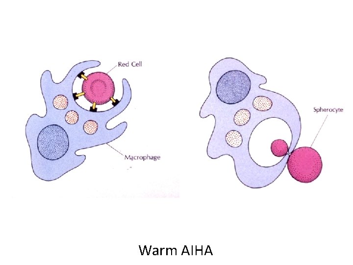 Warm AIHA 