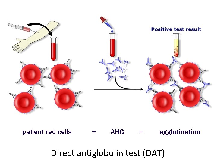 patient red cells + AHG = agglutination Direct antiglobulin test (DAT) 