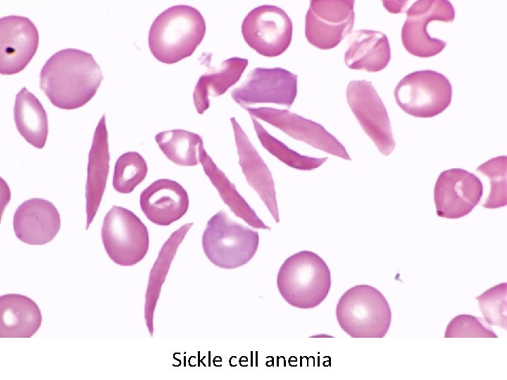 Sickle cell anemia 