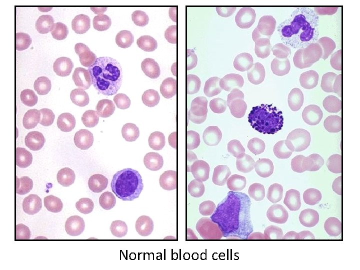 Normal blood cells 