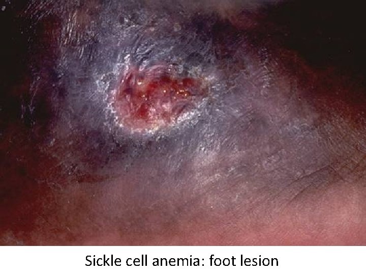 Sickle cell anemia: foot lesion 