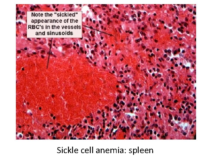 Sickle cell anemia: spleen 