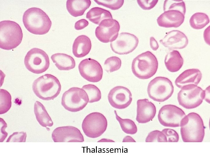 Thalassemia 