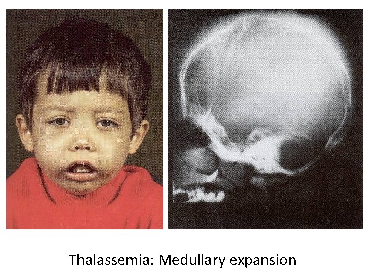 Thalassemia: Medullary expansion 