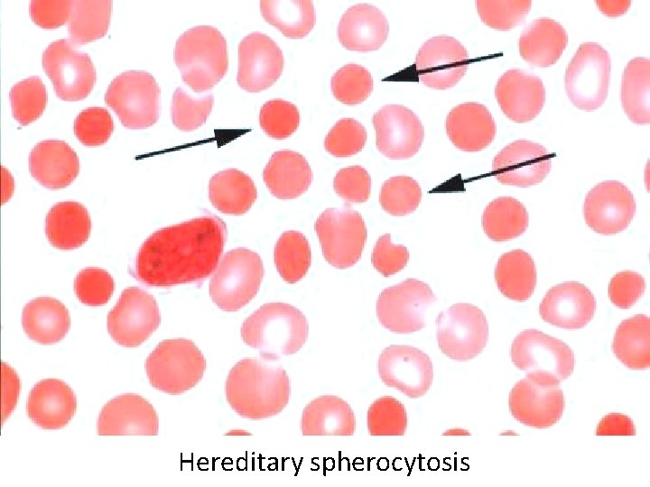 Hereditary spherocytosis 