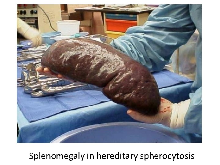 Splenomegaly in hereditary spherocytosis 