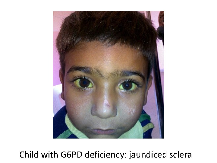 Child with G 6 PD deficiency: jaundiced sclera 