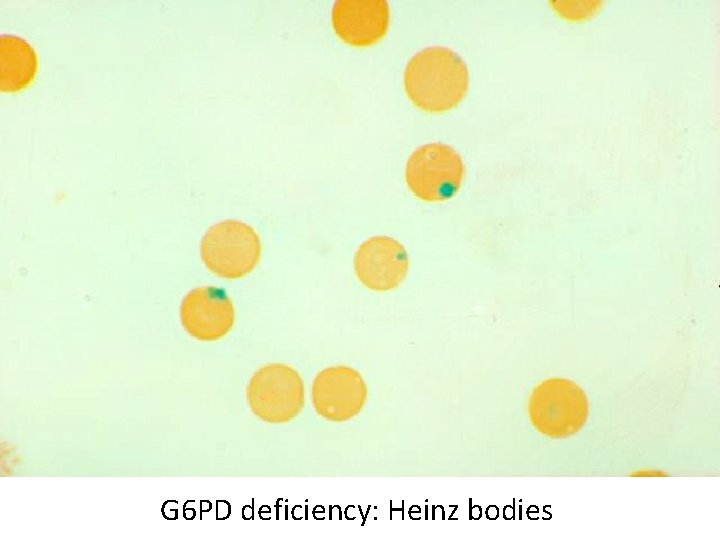 G 6 PD deficiency: Heinz bodies 