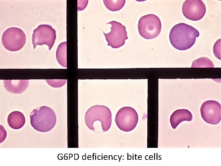 G 6 PD deficiency: bite cells 