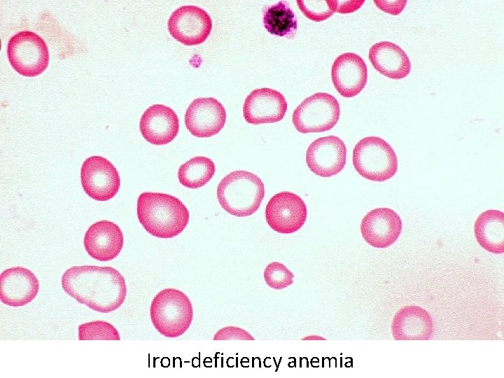 Iron-deficiency anemia 