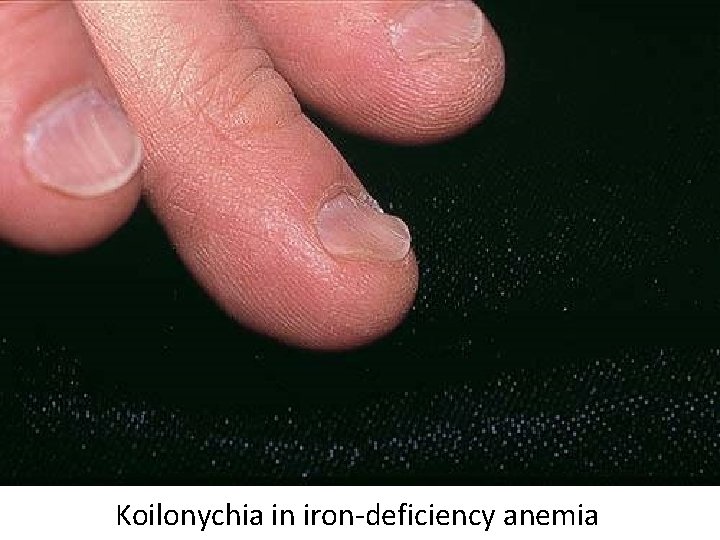 Koilonychia in iron-deficiency anemia 