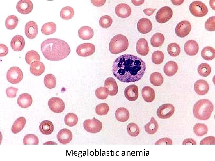 Megaloblastic anemia 