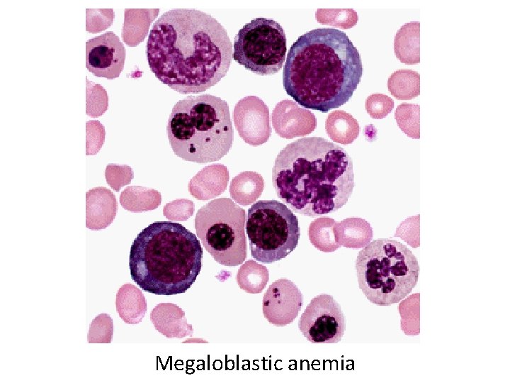 Megaloblastic anemia 