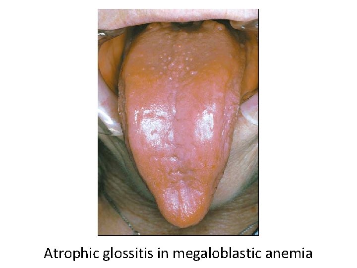 Atrophic glossitis in megaloblastic anemia 