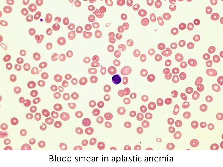 Blood smear in aplastic anemia 