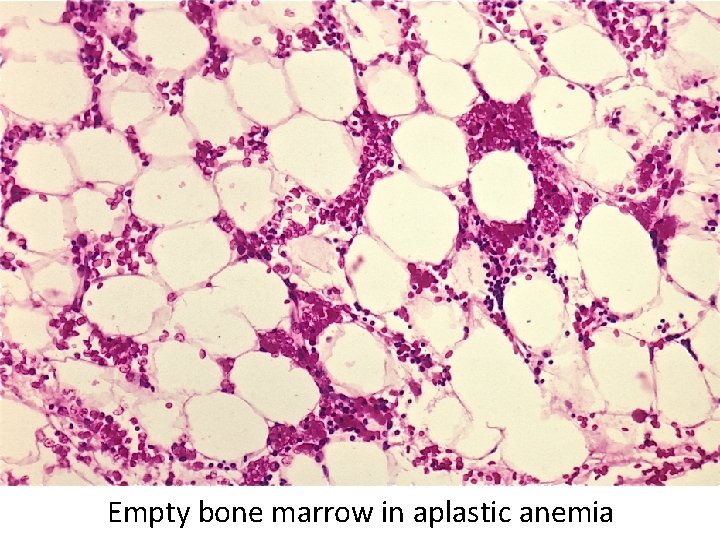 Empty bone marrow in aplastic anemia 